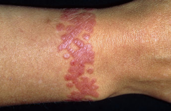 Rash. Close-up of a 39 year old woman's wrist showing a rash at the site of a tattoo. Tattoos are designs made on the skin by introducing permanent dyes into the skin layers. Here, an allergy to a part of the process caused the rash, an area of raised and reddened skin. Tattooing safely requires sterile conditions, as there is a risk of transmitting hepatitis or AIDS (acquired immune deficiency syndrome) through the needles used. Rashes can be treated with soothing skin creams such as calamine lotion, or antihistamine drugs to reduce the inflammation and itching.