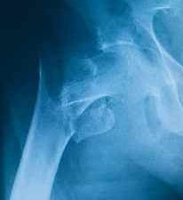 X-ray of broken hip