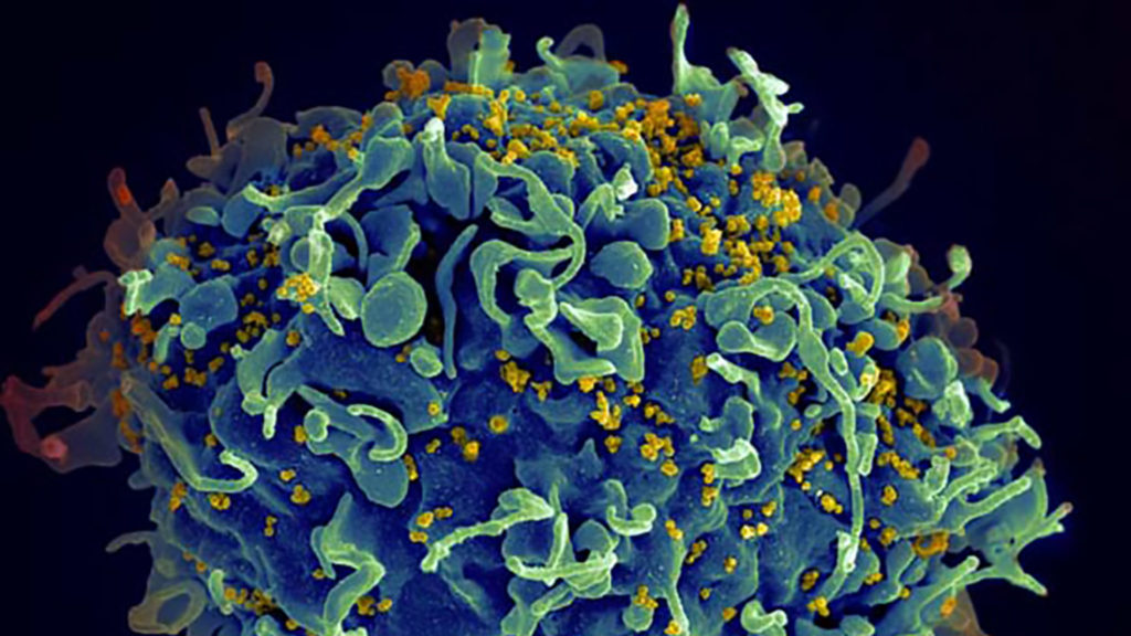 A human T cell, in blue, under attack by HIV, in yellow. NIH