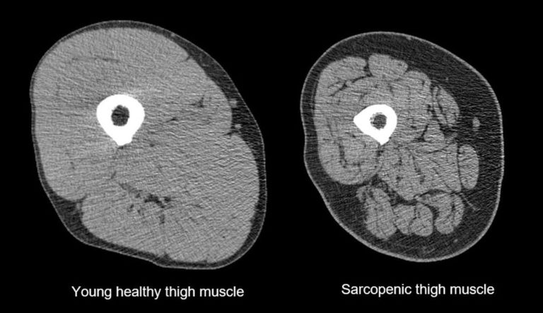 aging-what-is-sarcopenia-localhealthguide