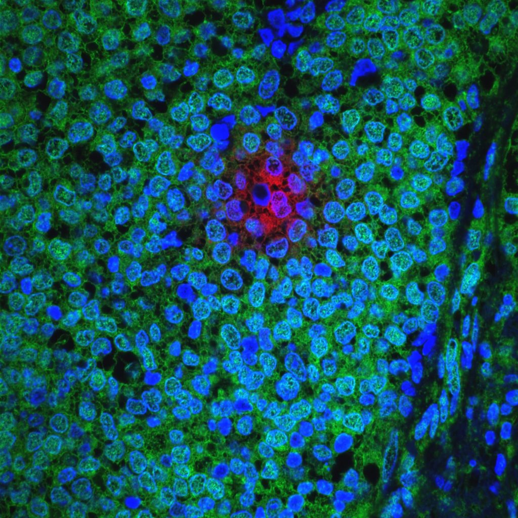 Human tumors often include slowly proliferating cancer cells that resist treatment. This image shows a cluster of slow-cycling (AKT-low/Hes1-high) breast cancer cells (red) within a human ER+ primary breast tumor (cell nuclei in blue; rapidly cycling, AKT-high, cancer cells in green). Cancer cells enter an AKT-low state in response to decreased interaction of cell surface beta-1 integrin with the extracellular matrix. AKT-low cancer cells within invasive breast cancer tumors persist after combination chemotherapy and contribute to tumor progression.