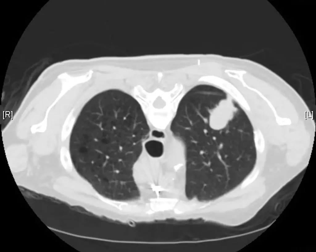 A low-dose CT scan can help with early detection of lung cancer. In this image, the tumor is the white nodule in the upper right corner of the black space.  Atlas of Pulmonary Pathology/Flickr, CC BY-SA