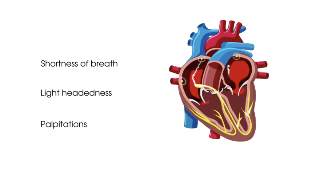 Graphic showing a diagram of the heart with a list of three common symptoms of atrial fibrillation: Shortness of breath, lightheadedness, and palpitations.