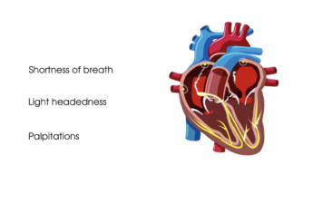Graphic showing a diagram of the heart with a list of three common symptoms of atrial fibrillation: Shortness of breath, lightheadedness, and palpitations.
