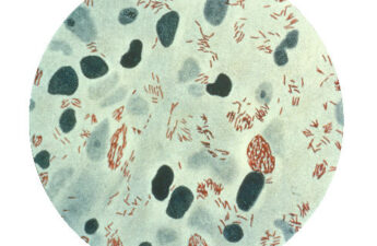 A photomicrograph of Mycobacterium leprae, the small brick-red rods, taken from a leprosy skin lesion