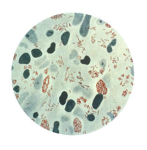 A photomicrograph of Mycobacterium leprae, the small brick-red rods, taken from a leprosy skin lesion 