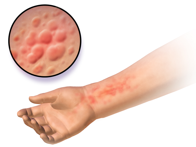 Illustration of an arm with hives