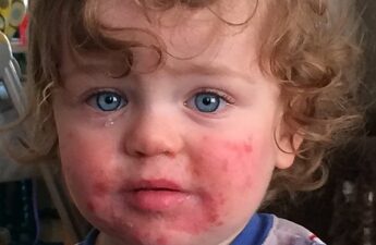 The "slapped cheek" appearance typical of fifth disease