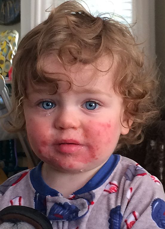 The "slapped cheek" appearance typical of fifth disease