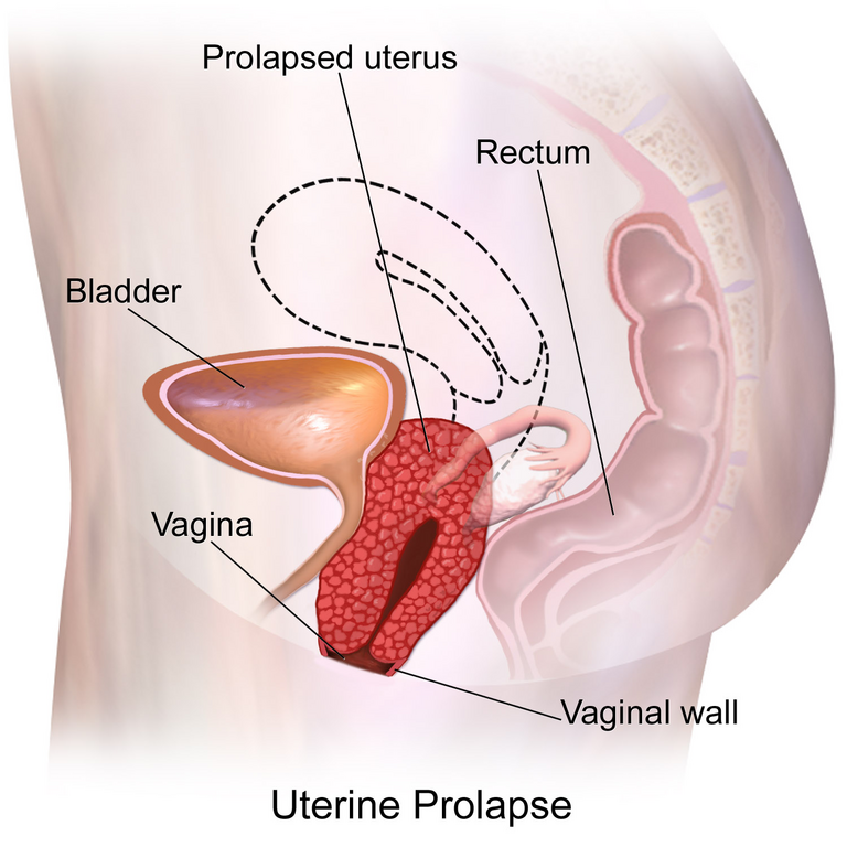 Depiction of uterine prolapse in which the uterus descending into the vaginal canal, towards the opening of the vagina