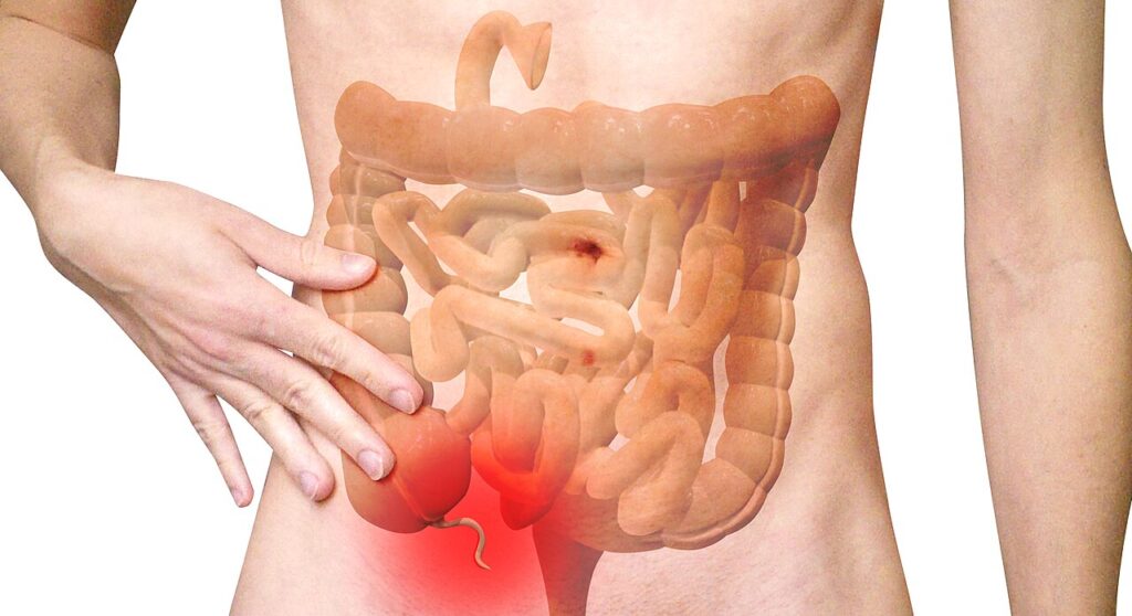 Illustration of the large and small bowel showing the location of the appendix.